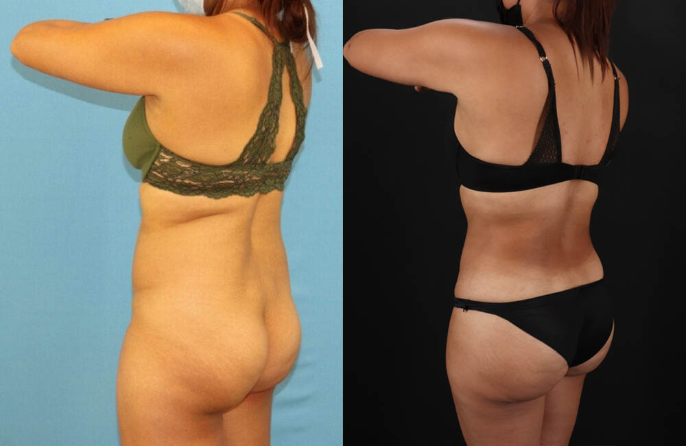 Brazilian Butt Lift case #5118
