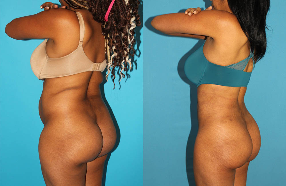 Brazilian Butt Lift case #4675