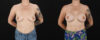 Breast Augmentation case #6491 slider thumbnail