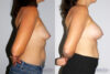 Breast Augmentation case #5622 slider thumbnail