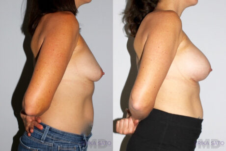 Breast Augmentation case #5622