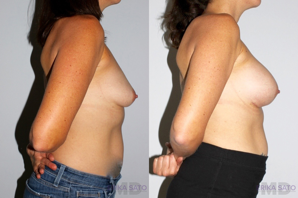 Breast Augmentation case #5622