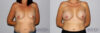 Breast Augmentation case #5622 slider thumbnail