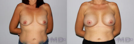 Breast Augmentation case #5622
