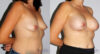 Breast Augmentation case #5622 slider thumbnail