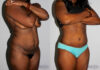 Tummy Tuck case #7094 slider thumbnail