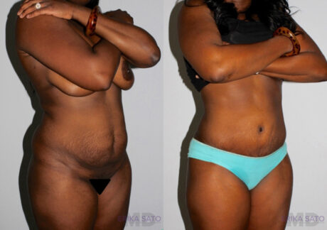 Tummy Tuck case #7094