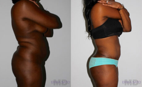 Tummy Tuck case #7094