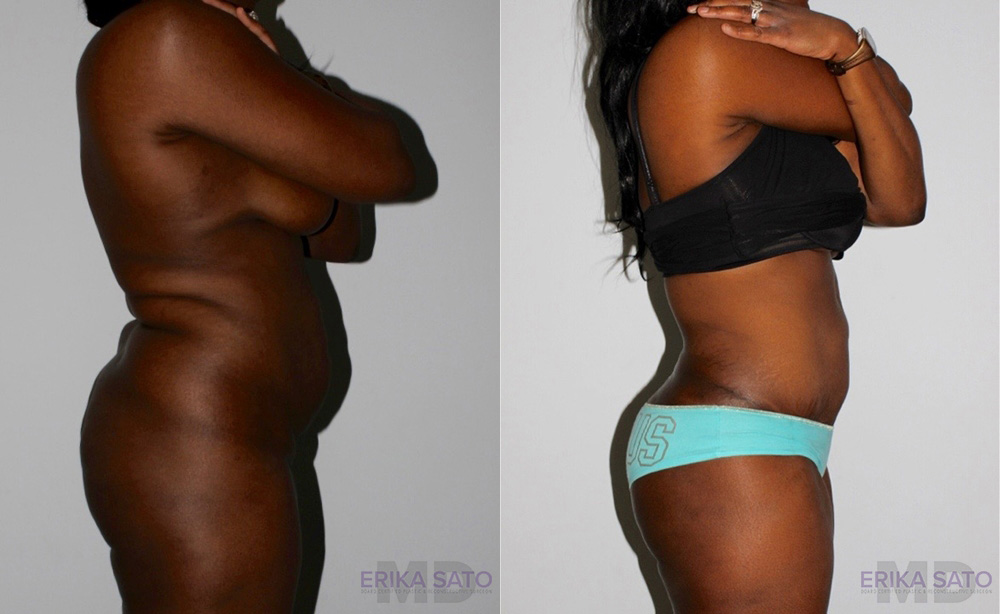 Tummy Tuck case #7094