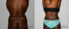 Tummy Tuck case #7094 slider thumbnail