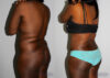 Tummy Tuck case #7094 slider thumbnail