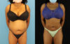 Liposuction case #6014 slider thumbnail