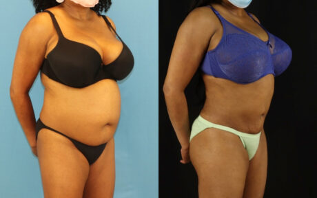 Liposuction case #6014