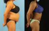 Liposuction case #6014 slider thumbnail