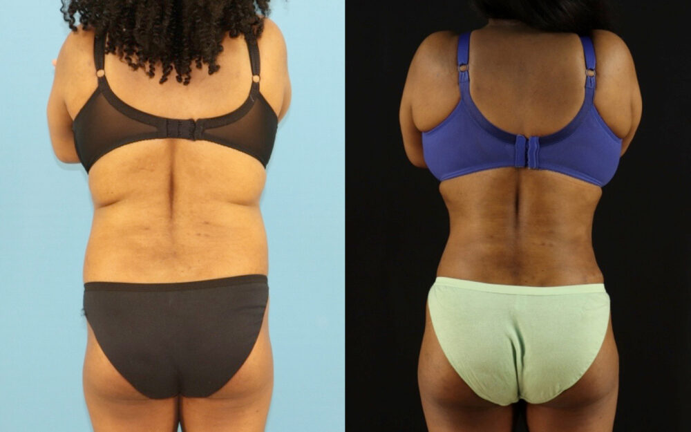 Liposuction case #6014