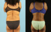 Liposuction case #6014 slider thumbnail