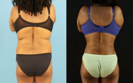 Liposuction case #6014
