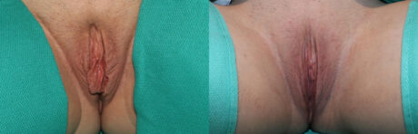 Labiaplasty case #5771