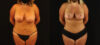 Mommy Makeover case #6515 slider thumbnail