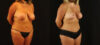 Mommy Makeover case #6515 slider thumbnail