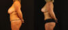 Mommy Makeover case #6515 slider thumbnail