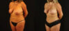 Mommy Makeover case #6515 slider thumbnail