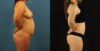 Mommy Makeover case #6514 slider thumbnail