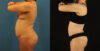 Mommy Makeover case #6514 slider thumbnail