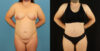 Mommy Makeover case #6514 slider thumbnail