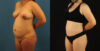 Mommy Makeover case #6514 slider thumbnail