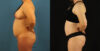 Mommy Makeover case #6514 slider thumbnail