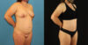 Mommy Makeover case #6514 slider thumbnail