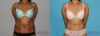 Tummy Tuck case #7227 slider thumbnail