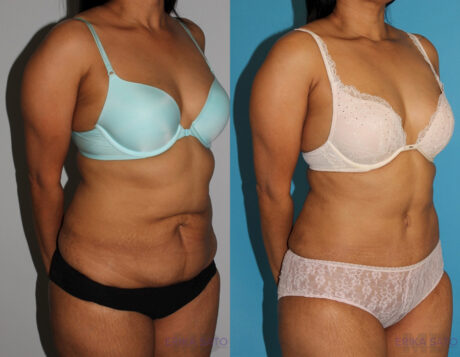Tummy Tuck case #7227