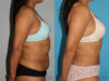 Tummy Tuck case #7227 slider thumbnail