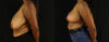 Breast Reduction case #7969 slider thumbnail