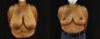 Breast Reduction case #7969 slider thumbnail