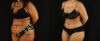 Tummy Tuck case #7350 slider thumbnail