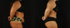 Tummy Tuck case #7350 slider thumbnail