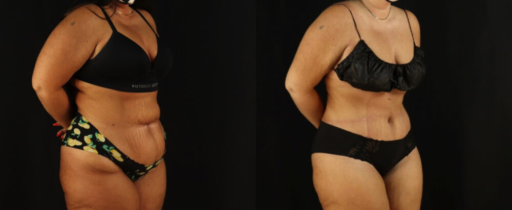 Tummy Tuck case #7350