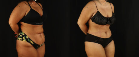 Tummy Tuck case #7350