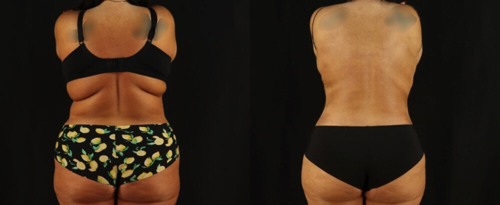 Tummy Tuck case #7350