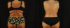 Tummy Tuck case #7350 slider thumbnail