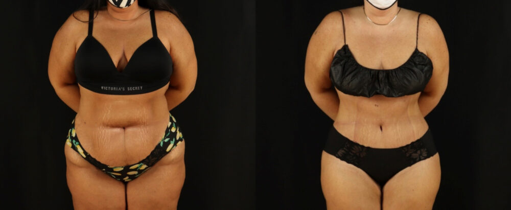 Tummy Tuck case #7350