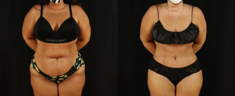 Tummy Tuck case #7350