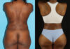 Tummy Tuck case #7277 slider thumbnail