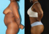 Tummy Tuck case #7277 slider thumbnail