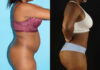 Tummy Tuck case #7277 slider thumbnail