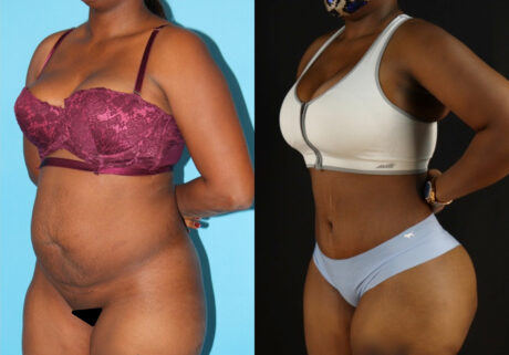 Tummy Tuck case #7277