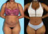 Tummy Tuck case #7277 slider thumbnail